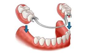 protese-parcial-removivel